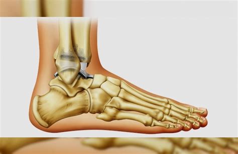 ayak bileğinin deforme olan artrozu